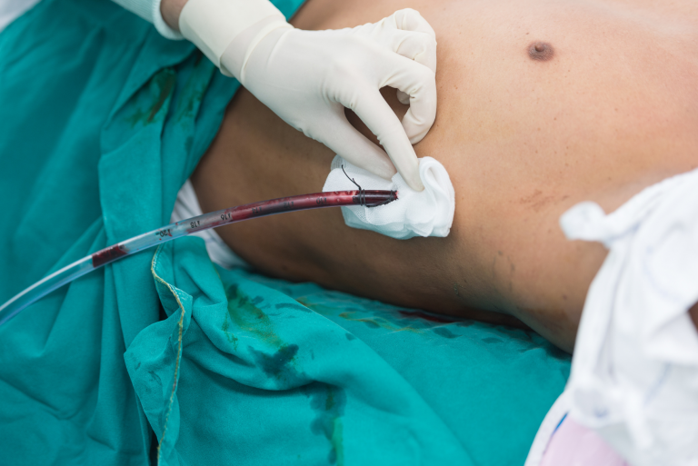 drenagem pleural