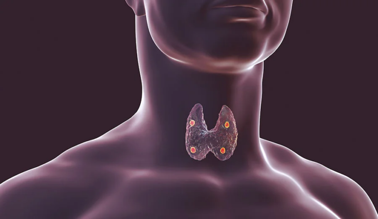 Hipoparatireoidismo pós-tireoidectomia: sintomas, diagnóstico e tratamento