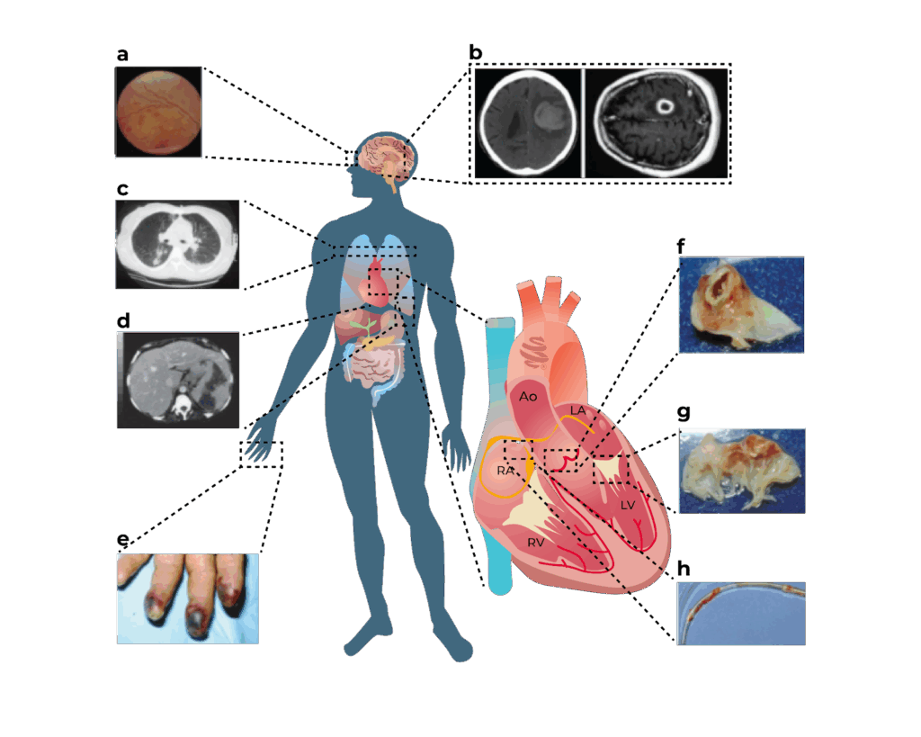 Ilustração do corpo humano com esquema do coração e imagens médicas associadas a diferentes órgãos e tecidos, representando manifestações sistêmicas de uma doença.