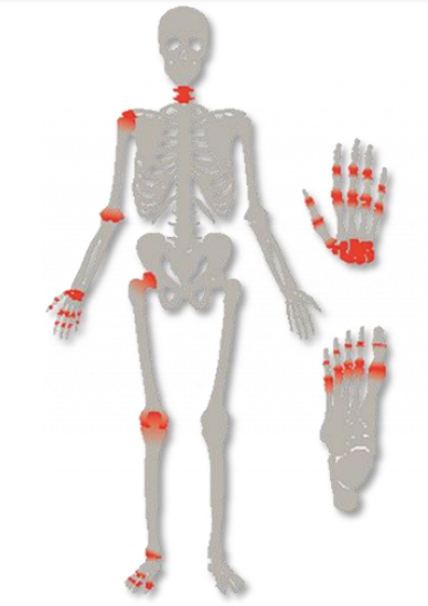 Ilustração Artrite Reumatoide: Achados típicos