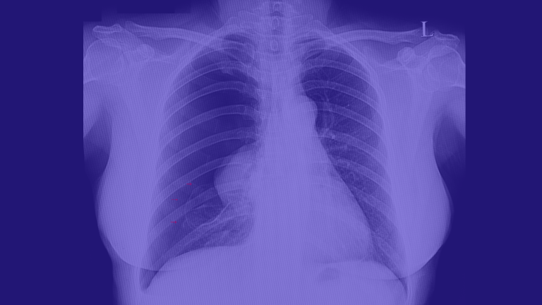 pneumotórax, pneumotórax hipertensivo, pneumotórax espontâneo, pneumotórax traumático, pneumotórax causas, pneumotórax raio x