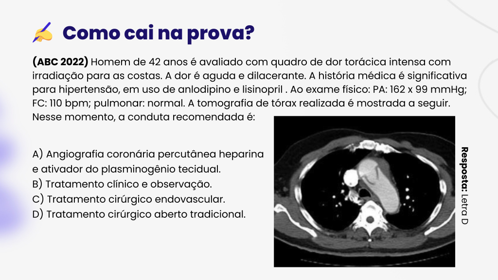 Classificação de Stanford e DeBakey para a Dissecção de Aorta: A identificação deste quadro e a classificação precisa é essencial....