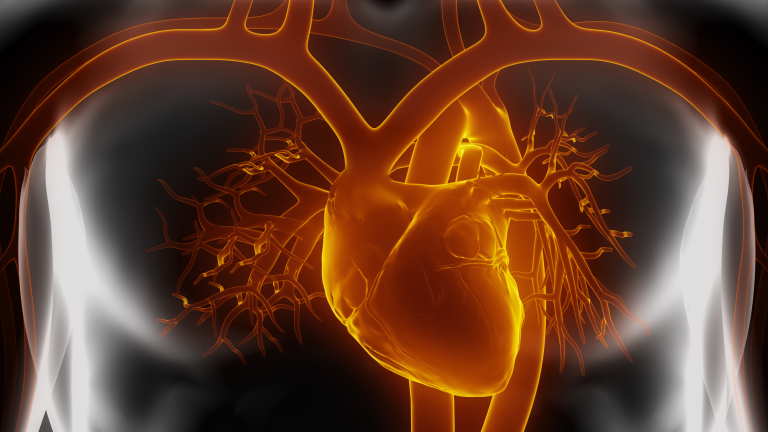 classificacao de stanford, disseccao aguda de aorta, dissecção aguda da aorta, dissecção aórtica aguda, disseccao aortica, dissecção de aorta