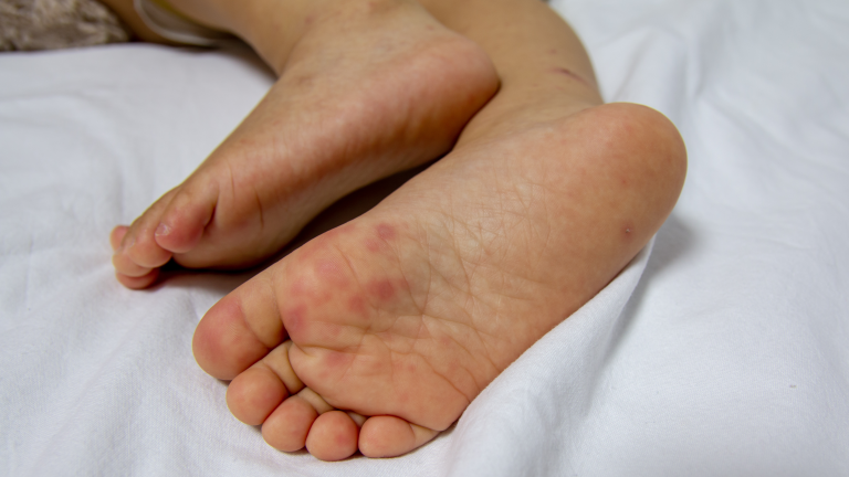 sindrome pe mao e boca, síndrome mão pé boca tratamento, síndrome mão-pé-boca tratamento, síndrome mão-pé-boca, síndrome de pé mão e boca , síndrome pé mão boca