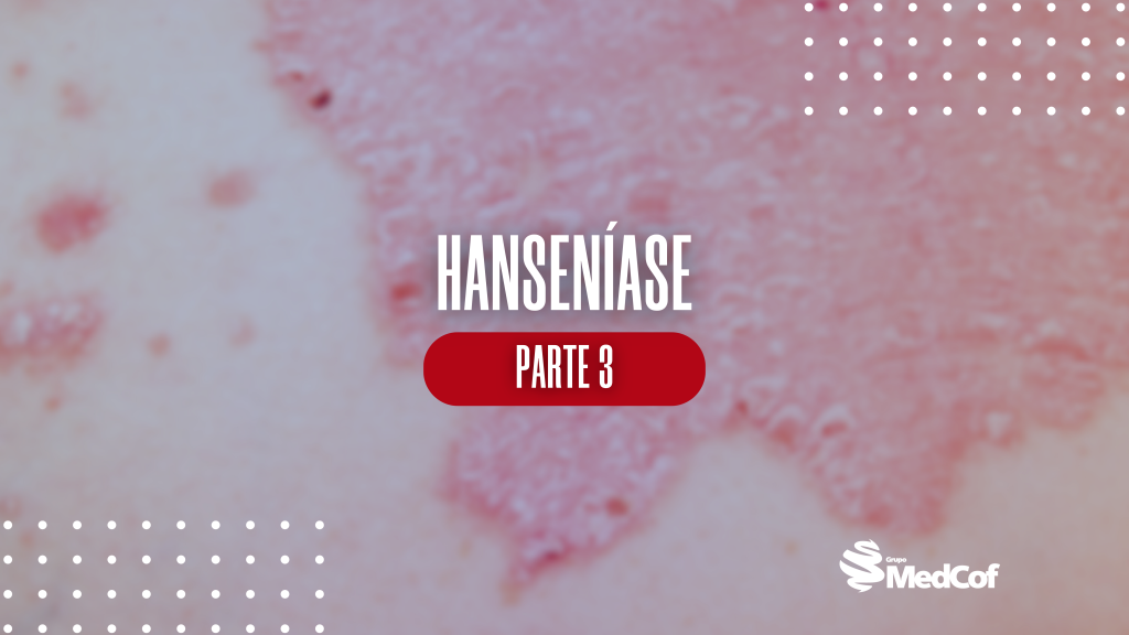 fenômeno de lucio, fenomeno de lucio, reacoes hansenicas, reações hansenicas, reações hansênicas, hanseníase fotos, hanseníase, clínica hanseníase, reação hansênica, reação hansênica tipo 1, reação hansênica tipo 2, reacao hansenica, reação hansenica, reação hansenica tipo 1, reação hansenica tipo 2, reacao hansênica, reacao hansênica tipo 1, reacao hansênica tipo 2