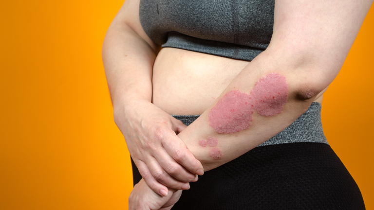 hanseniase diagnostico, hanseniase tratamento, hanseníase tratamento, hanseníase diagnóstico, diagnóstico da hanseníase, como é feito o diagnóstico da hanseníase, diagnóstico hanseníase, exame para diagnóstico de hanseníase, tratamento da hanseníase, tratamento para hanseníase, tratamento hanseníase, hanseníase