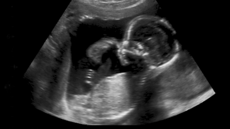 pocus ultrassom, ultrassom pocus, pocus trauma, pocus no trauma, Point of Care Ultrassound