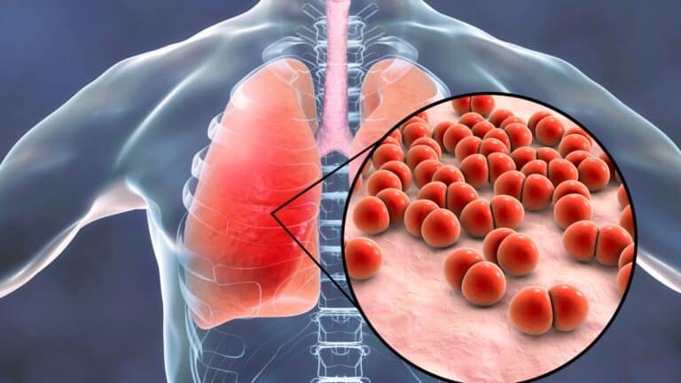Entenda a Pneumonia Complicada e saiba como identificar