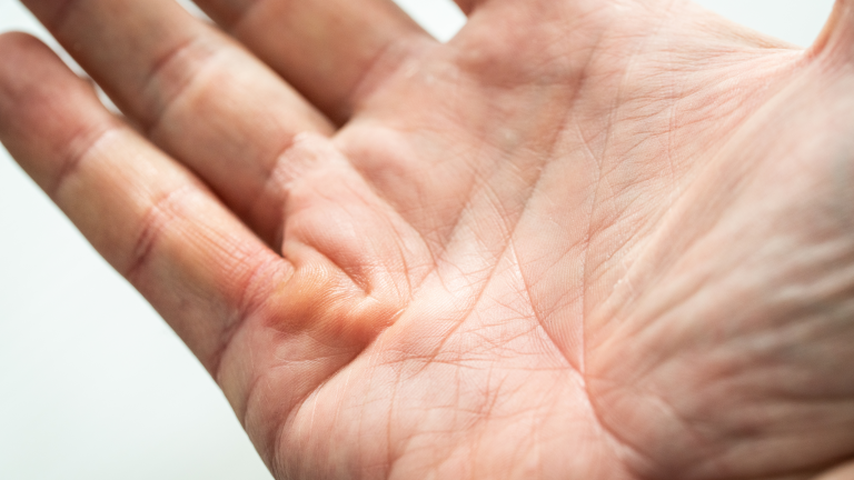 fibromatose palmar, moléstia de dupuytren, contratura palmar de dupuytren, contraturas de dupuytren, contratura palmar de dupuytren, doenca de dupuytren,