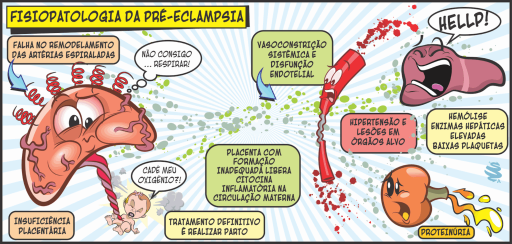 Fisiopatologia da pré-eclâmpsia explicada com desenhos didáticos: imagem mostra a insuficiência placentária causada pela falha no remodelamento das artérias espiraladas; lesões vasculares com liberação de citocinas inflamatórias; hipertensão; síndrome HELLP (hemólise, enzimas hepáticas elevadas e baixa contagem de plaquetas); proteinúria e o tratamento definitivo com parto. Ideal para entender as alterações sistêmicas dessa condição gestacional.