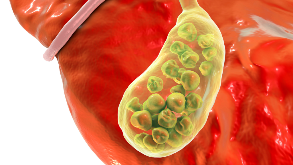 coledocolitíase sintomas, o que é coledocolitíase, coledocolitíase tratamento, coledocolitiase