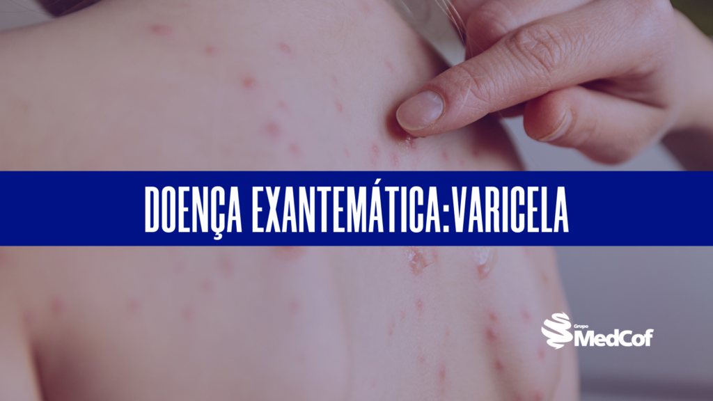 doenca exantematica varicela