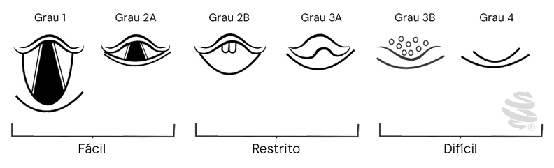 Classificação de Cook modificada com 6 graus de visualização da laringe: Grau 1 e 2A (fácil: glote e estruturas laringeanas visíveis); Grau 2B e 3A (restrito: epiglote ou aritenoides parcialmente visíveis); Grau 3B e 4 (difícil: estruturas invisíveis ou apenas bolhas de ar presentes). Indicado para avaliação das condições da via aérea em anestesia e intubação difícil.