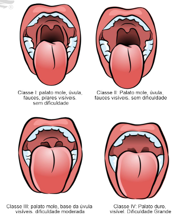 Ilustração da classificação de Mallampati em quatro etapas para a avaliação da via aérea: Classe I (visualização completa de úvula, pilares e palato mole), Classe II (visualização parcial da úvula e palato), Classe III (apenas base da úvula visível) e Classe IV (somente palato duro visível). Imagem essencial para estudos de anestesiologia e preparação para manejo de vias aéreas.