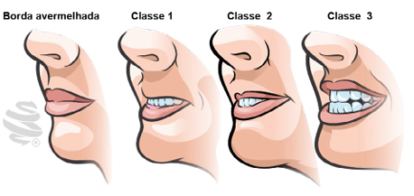 Ilustração detalhando o Upper-Lip Bite Test (ULBT), utilizado para prever a dificuldade de intubação. Classificação em quatro categorias: borda avermelhada (referência do lábio em repouso), Classe 1 (lábio inferior cobre totalmente o superior, indicando boa mobilidade), Classe 2 (cobertura parcial do lábio superior pelo lábio inferior, sugerindo dificuldade moderada) e Classe 3 (lábio inferior não alcança o superior, indicando alta dificuldade de intubação). Ferramenta essencial para avaliação pré-anestésica.