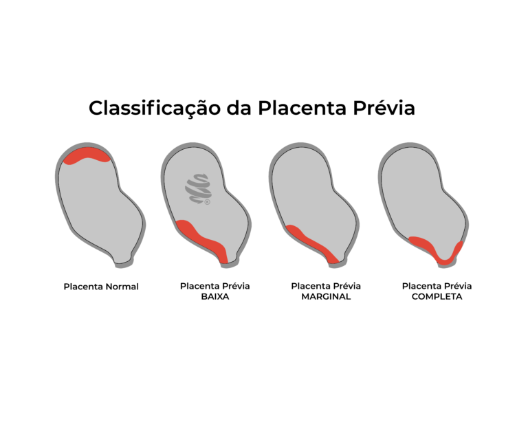 Ilustração comparativa mostrando a classificação da placenta prévia em quatro tipos: placenta normal, placenta prévia baixa, placenta prévia marginal e placenta prévia completa.