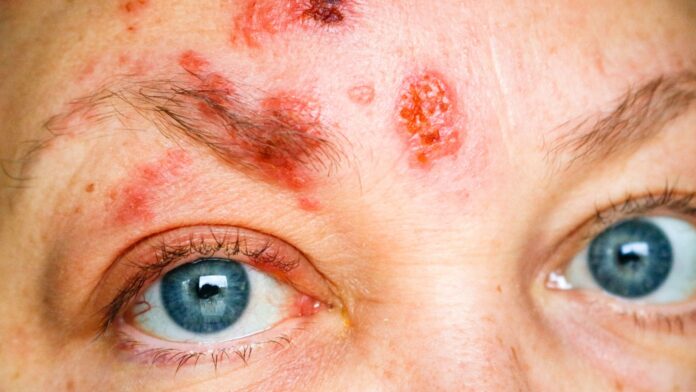 O Herpes-Zóster, também conhecido como cobreiro, é uma condição que possui origem no vírus da Varicela-Zóster - responsável pela Catapora - mas que permanece latente no corpo, podendo se reativar mais tarde, causando assim a doença, especialmente, em estados de imunossupressão.