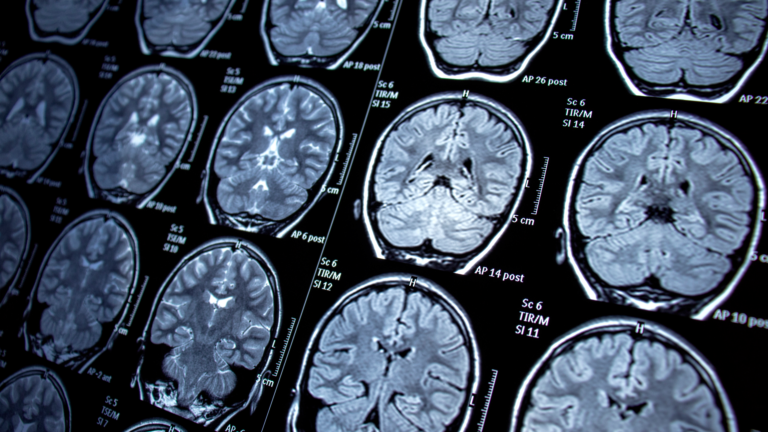 Curiosidades Sobre Residência em Neurologia