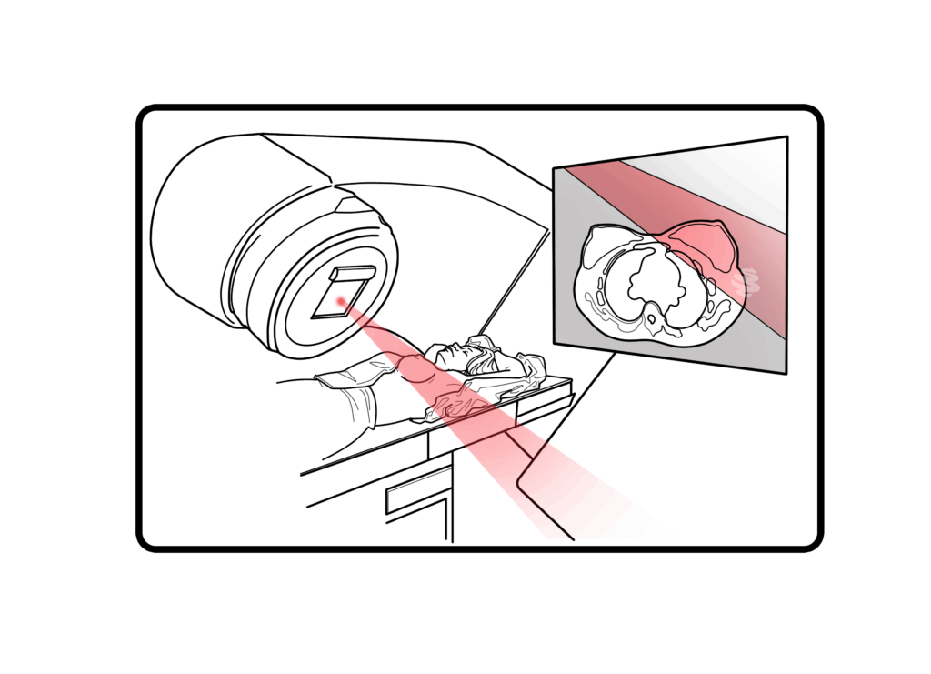 Ilustração de radioterapia médica com equipamento de alta precisão. Feixe de luz vermelho direciona o tratamento ao tórax do paciente deitado, enquanto uma tela exibe a área do tumor alvo. Representação clara do processo de terapia por radiação para combater tumores localizados.