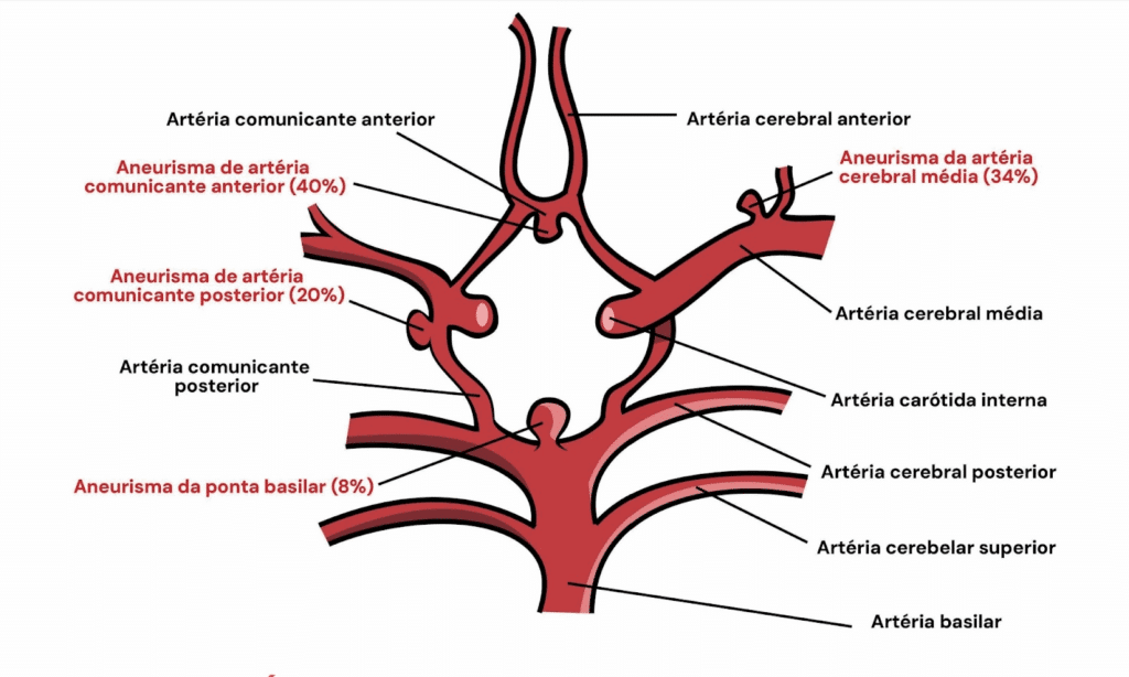 Ilustração do polígono de Willis mostrando a vascularização cerebral com locais mais frequentes de aneurismas: artéria comunicante anterior (40%), artéria cerebral média (34%), artéria comunicante posterior (20%) e ponta da artéria basilar (8%).