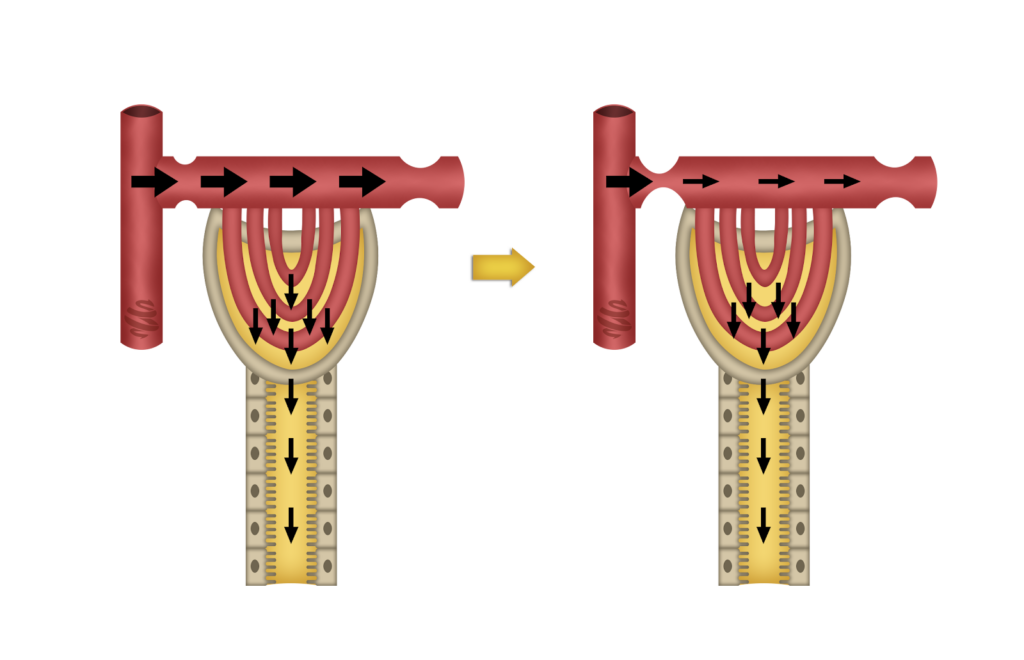 A imagem ilustra a fisiologia de funcionamento dos glomérulos renais, destacando o processo de filtração glomerular. O sangue flui pelo capilar aferente (encanamento em vermelho) em direção aos capilares glomerulares, onde ocorre a separação seletiva de substâncias. As setas indicam o movimento da filtragem do plasma, que é transportado do sangue para o espaço de Bowman (área amarela), seguindo rumo aos túbulos renais para reabsorção ou excreção. O capilar eferente, de menor calibre, conduz o sangue restante, regulando a pressão glomerular para manter a taxa de filtração eficiente.