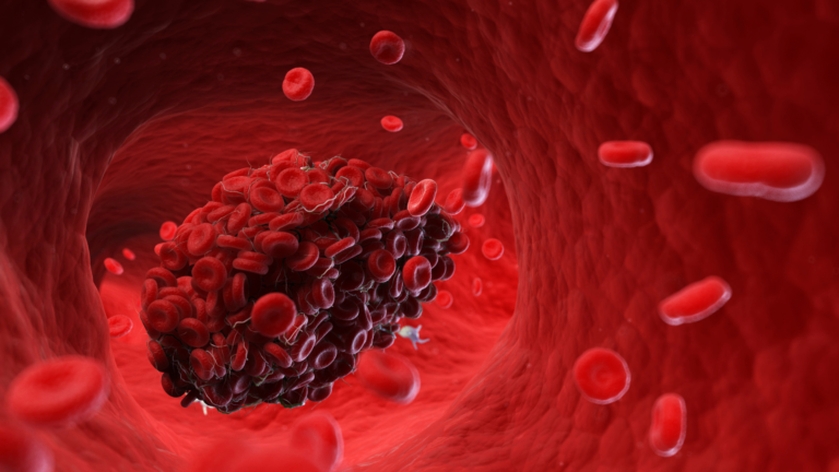 Preparação para Residência em Onco-hematologia: Púrpura Trombótica