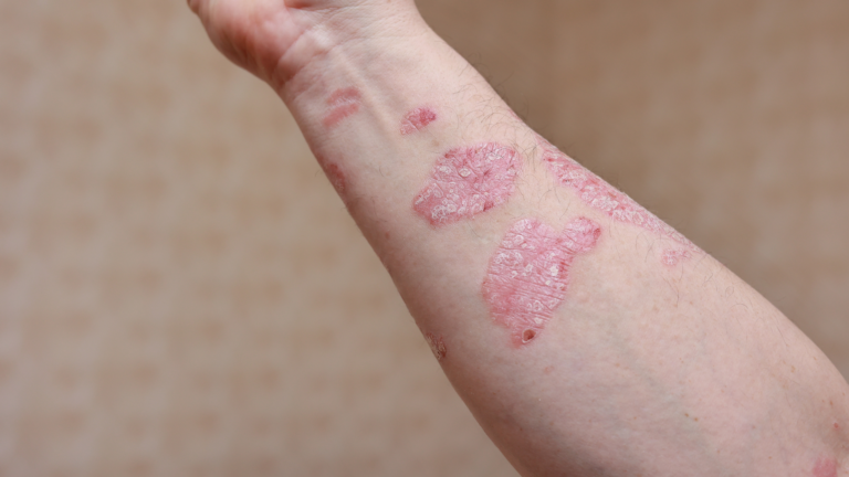 O que são as Dermatoses Bolhosas e como tratar?