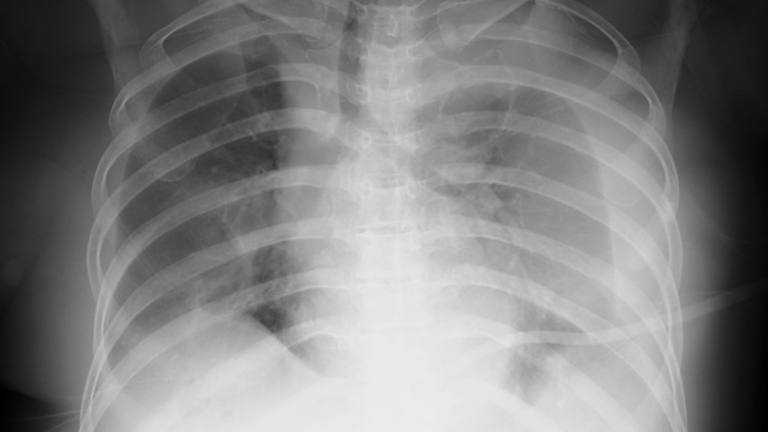 Curiosidades sobre o derrame pleural