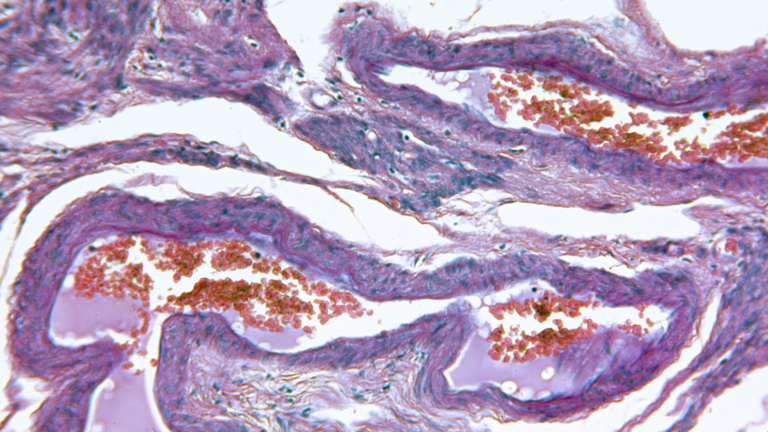 Saiba como diagnosticar uma Hiperplasia Endometrial