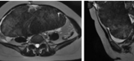 Imagem de exame radiológico mostrando tumor sólido em ovário. À esquerda, corte axial detalha a localização e estrutura do tumor na região abdominal. À direita, corte sagital evidencia as características do tumor em perfil. Diagnóstico diferencial do carcinoma ovariano com imagens de ressonância magnética ou tomografia computadorizada.