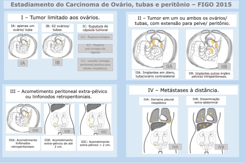 A imagem é um quadro explicativo sobre o Estadiamento do Carcinoma de Ovário, Tubas e Peritônio, baseado na classificação FIGO 2015. Está dividida em quatro categorias principais numeradas de I a IV, contendo subdivisões de A a C, dependendo da extensão do câncer. A imagem apresenta diagramas anatômicos simplificados para ilustrar a progressão do câncer e sua disseminação, com textos em caixas de fundo azul claro ao lado de cada diagrama.Estágio I (Tumor limitado aos ovários):Inclui os subníveis IA e IB, que descrevem o câncer restrito a um ou ambos os ovários/tubas.
O estágio IC detalha características de ruptura de cápsula, lavado peritoneal ou citologia positiva.
Diagramas mostram o tumor confinado aos ovários ou tuba uterina.
Estágio II (Extensão limitada à pelve/peritônio):Subclassificações IIA e IIB indicam implantes tumorais nos órgãos pélvicos ou peritoneais.
Ilustrações mostram a extensão para o útero, ovário contralateral e outros órgãos pélvicos.
Estágio III (Comprometimento peritoneal ou linfonodos retroperitoneais):Subdividido em IIIA (linfonodos comprometidos), IIIB (implantes ≤ 2 cm) e IIIC (implantes > 2 cm).
Os diagramas ilustram acometimento peritoneal e linfonodos.
Estágio IV (Metástases a distância):IVA e IVB indicam disseminação do câncer para órgãos distantes, como o pulmão ou a cavidade abdominal.
Desenhos anatômicos mostram derrame pleural ou metástases extra-abdominais.