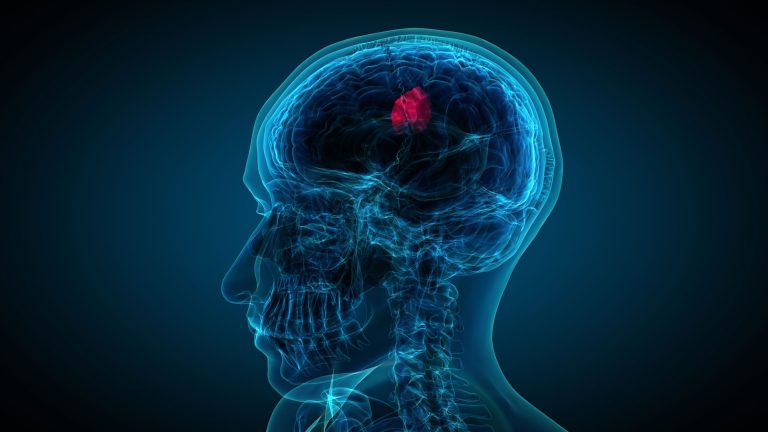Classificação dos Tumores Neuroendócrinos 