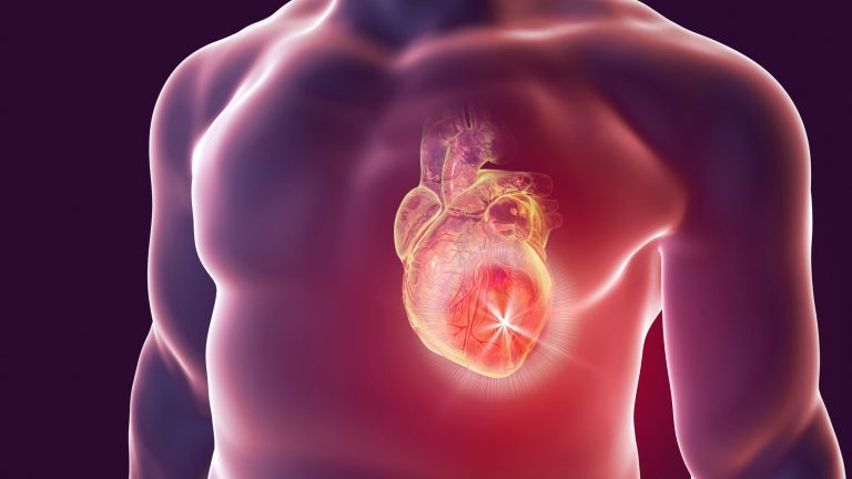 Dicas para residência em Cirurgia: Quais são as indicações Cirúrgicas para Doença Coronariana