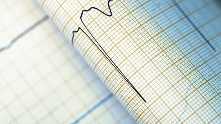 Análises do ECG em casos de Taquiarritmia