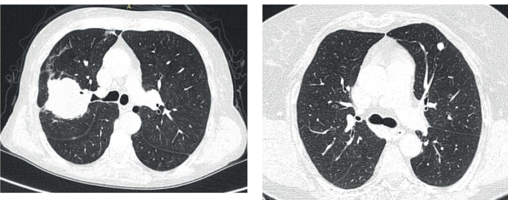 Tomografia computadorizada do tórax mostrando, à esquerda, nódulo pulmonar e, à direita, massa pulmonar em diferentes regiões do pulmão humano.
