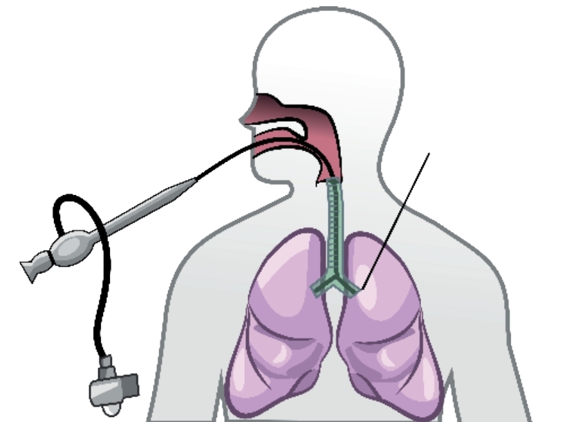Ilustração médica mostrando o uso do broncoscópio introduzido pela via oral até a traqueia e brônquios para exame e manejo das vias aéreas e pulmões.