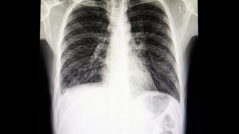 Exsudato neutrofílico: um tipo sério de derrame pleural