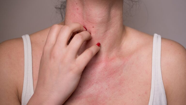Angioedema: uma consequência da alergia e suas diferenças da rinite e DPV