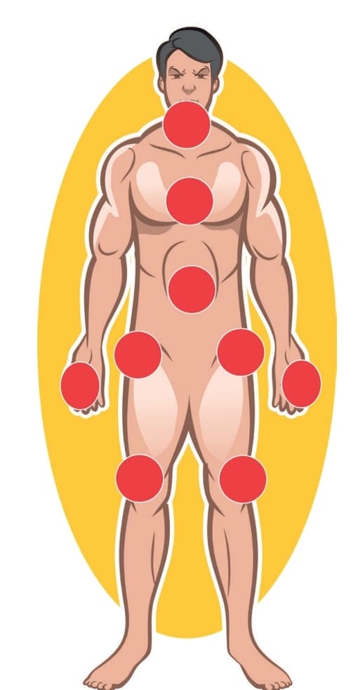 A ilustração mostra um homem em posição ereta, destacando regiões comuns de dor corporal de artrite, representadas por círculos vermelhos nos ombros, cotovelos, joelhos, abdômen e cabeça. Essa imagem é frequentemente utilizada para ilustrar sintomas de condições como fibromialgia, artrite ou pontos de pressão. A expressão facial de desconforto reforça a presença de dor nas áreas indicadas.