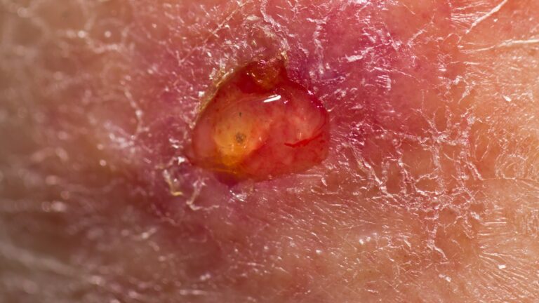 Pioderma Gangrenoso: entenda os aspectos essenciais desta Dermatose Neutrofílica