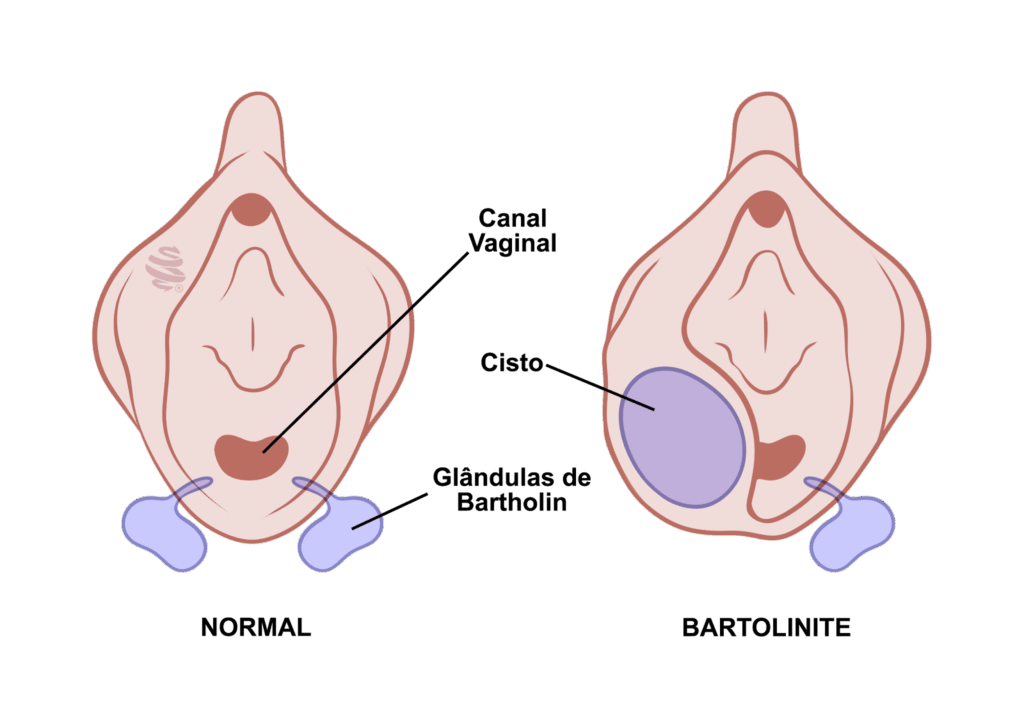 Ilustração médica comparativa do sistema reprodutivo feminino destacando diferenças entre anatomia saudável e a presença de cisto ou abscesso de Bartholin. Veja como as glândulas de Bartholin se apresentam em condições normais e patologias, ajudando no diagnóstico de cistos ou abcessos.