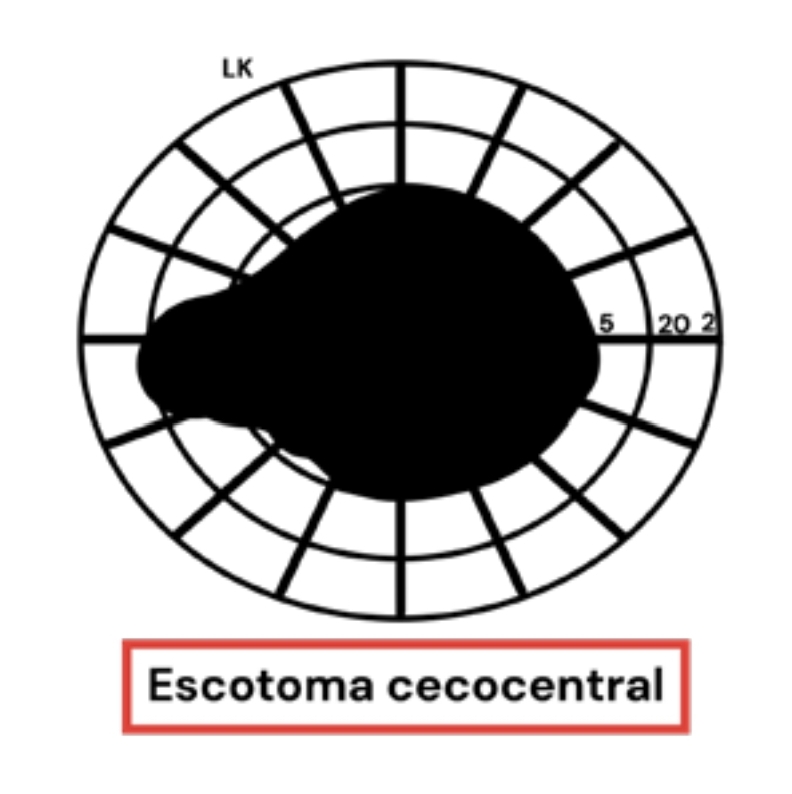 Explore tudo sobre o teste de campo visual para escotoma cecocentral. Entenda como essa condição impacta a visão central, suas causas potenciais, como a neurite óptica, e as implicações para a saúde ocular. Aprenda a interpretar diagramas de seu teste de perimetria para melhor diagnóstico e tratamento. Descubra informações valiosas para pacientes e profissionais de saúde ocular sobre o tratamento de neuropatias ópticas e métodos eficazes para gerenciar escotomas.
