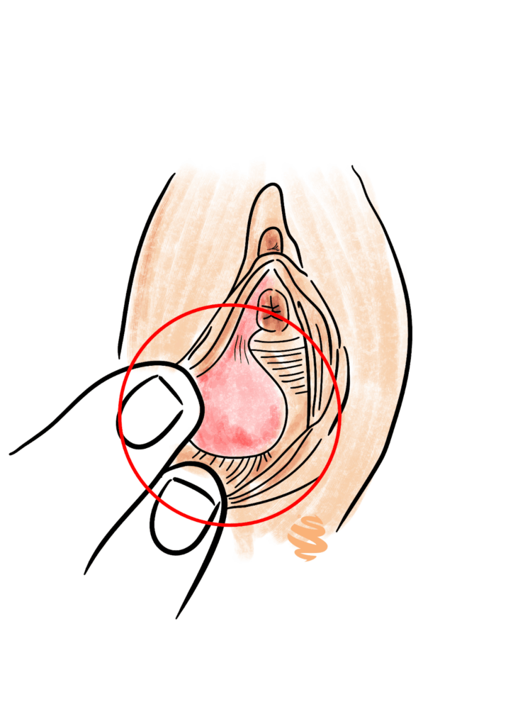 Ilustração anatômica da vulva com foco em possível condição na glândula de Bartholin. Destaca estruturas como clitóris e lábios, com ênfase em área inflamada, usada para fins educacionais.