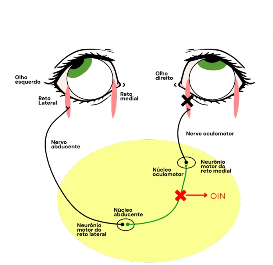 Diagrama de oftalmoplegia internuclear mostrando lesão no fascículo longitudinal medial entre núcleos abducente e oculomotor, com falha de adução do olho direito e movimento normal do olho esquerdo