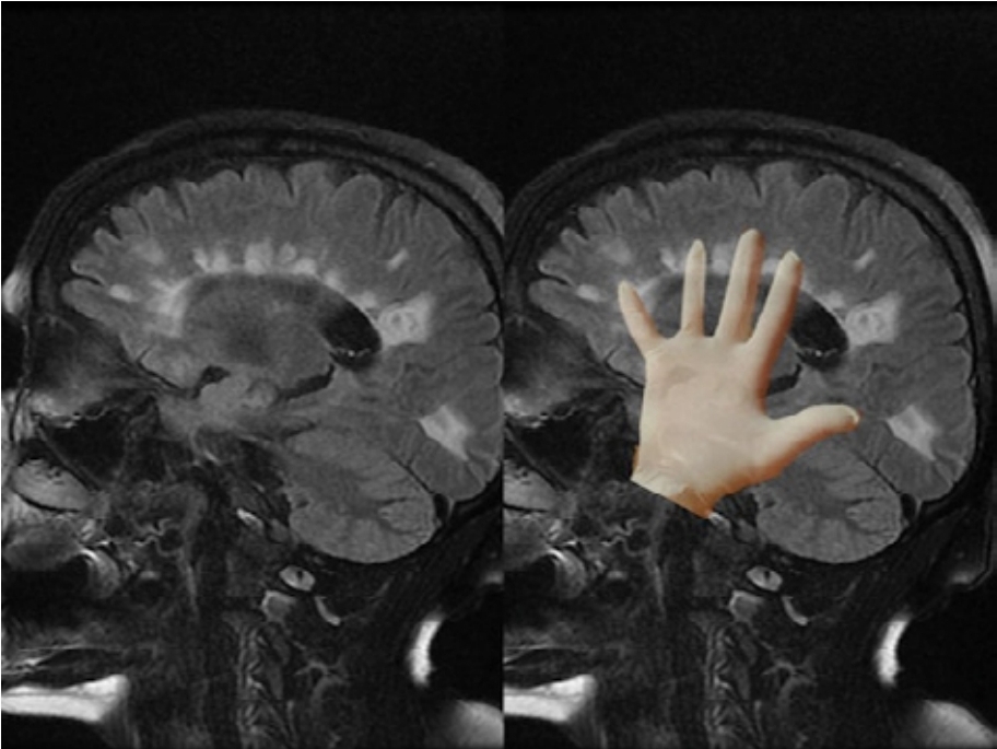 Ressonância magnética sagital T2 mostrando Dawson’s fingers em esclerose múltipla, com sobreposição de mão translúcida destacando lesões desmielinizantes