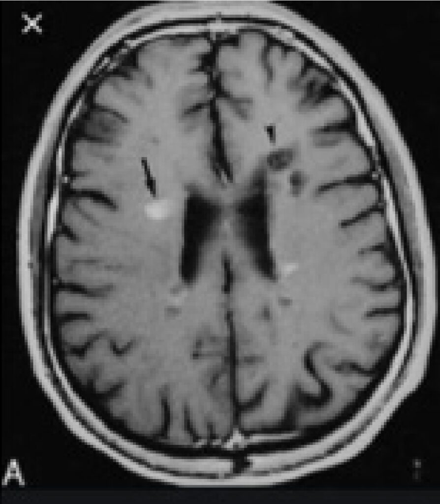 Ressonância magnética axial do cérebro com lesão hiperintensa contrastada e área hipointensa não contrastante, indicativa de atividade inflamatória e lesão crônica em doença desmielinizante