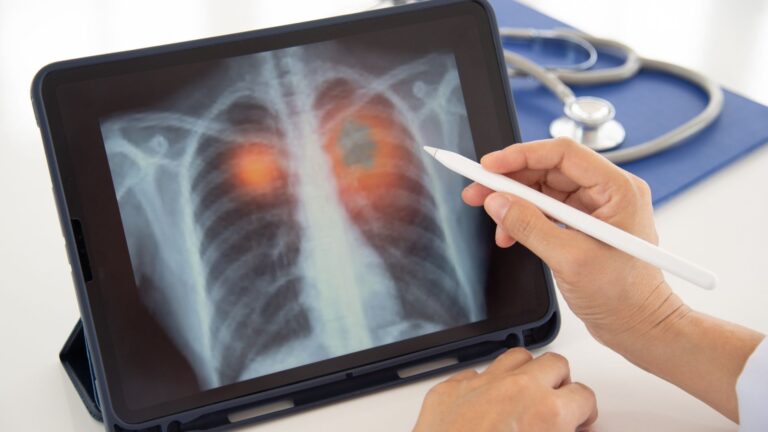 Tipos de pneumonia: classificação, quadro clínico e conduta