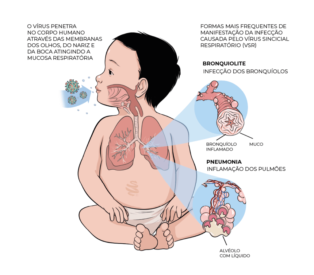 Ilustração detalhada mostrando como o Vírus Sincicial Respiratório (RSV) afeta o sistema respiratório de uma criança, com destaque para bronquiolite e pneumonia. A imagem inclui uma criança sentada de fralda com uma sobreposição do sistema respiratório indicando traqueia, brônquios e pulmões, partículas virais em direção ao nariz e boca, e diagramas ampliados de bronquiolite e pneumonia. Ideal para conteúdos educativos sobre saúde infantil, infecções respiratórias e cuidados pediátricos. Arte médica com fundo branco, explicativo e informativo.