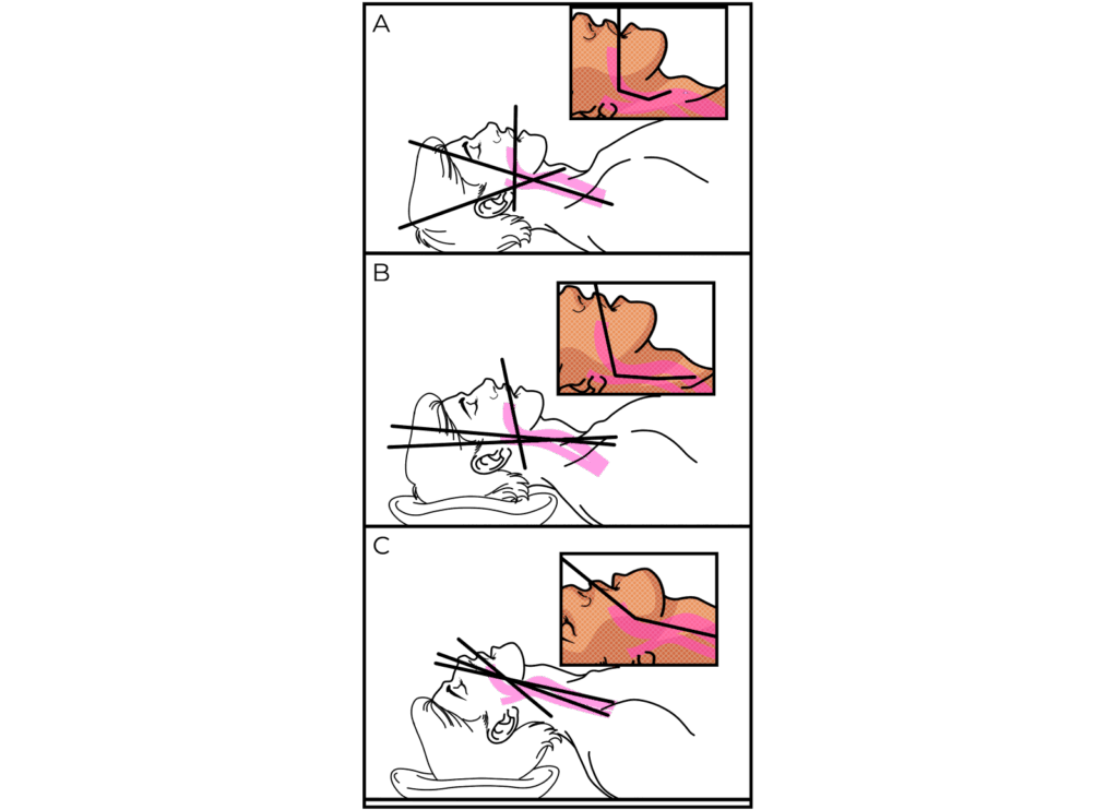 A imagem compara a posição incorreta e a aplicação adequada da manobra Jaw-Thrust para abertura das vias aéreas. No painel a, a mandíbula está retraída e o queixo caído, o que causa colapso ou obstrução parcial das vias respiratórias. Já no painel b, observamos a posição correta, em que a mandíbula foi projetada para frente com auxílio manual, promovendo a desobstrução completa das vias aéreas e garantindo fluxo respiratório adequado. Este posicionamento é crucial em emergências médicas, como em pacientes inconscientes ou em situações de reanimação. Imagem educativa voltada para socorristas, paramédicos e estudantes de áreas médicas.