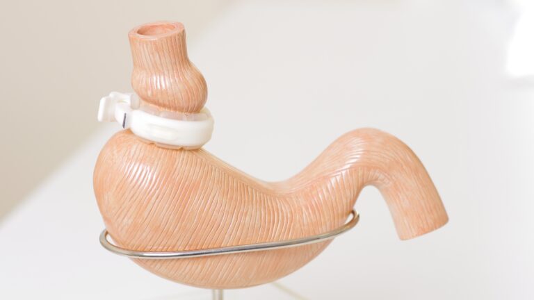 Saiba as complicações após a cirurgia bariátrica